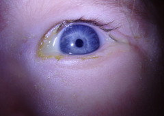 Obr. 1 Sekrece a slzení levého oka kojence.